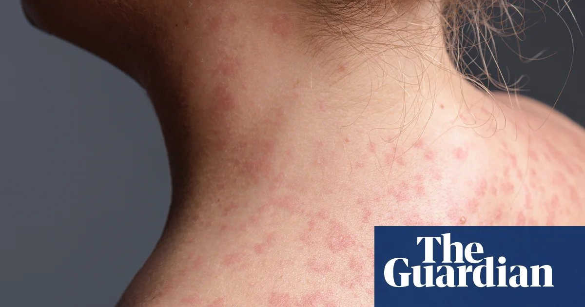 Rise in holiday measles infections sparks health alerts in NSW, SA and Victoria | Health
