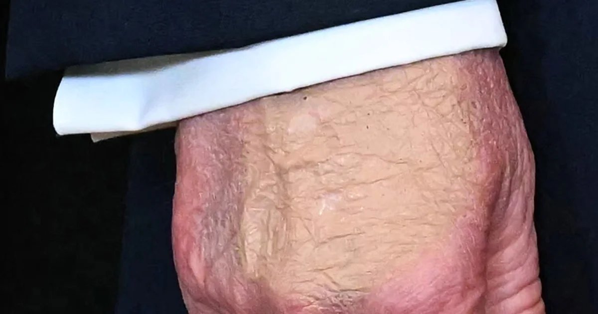 Trump defends health after concerns over bruised hand