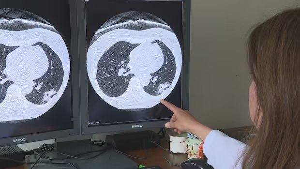 Nova Scotia’s lung screening program finds dozens of cancer cases in first 2 years
