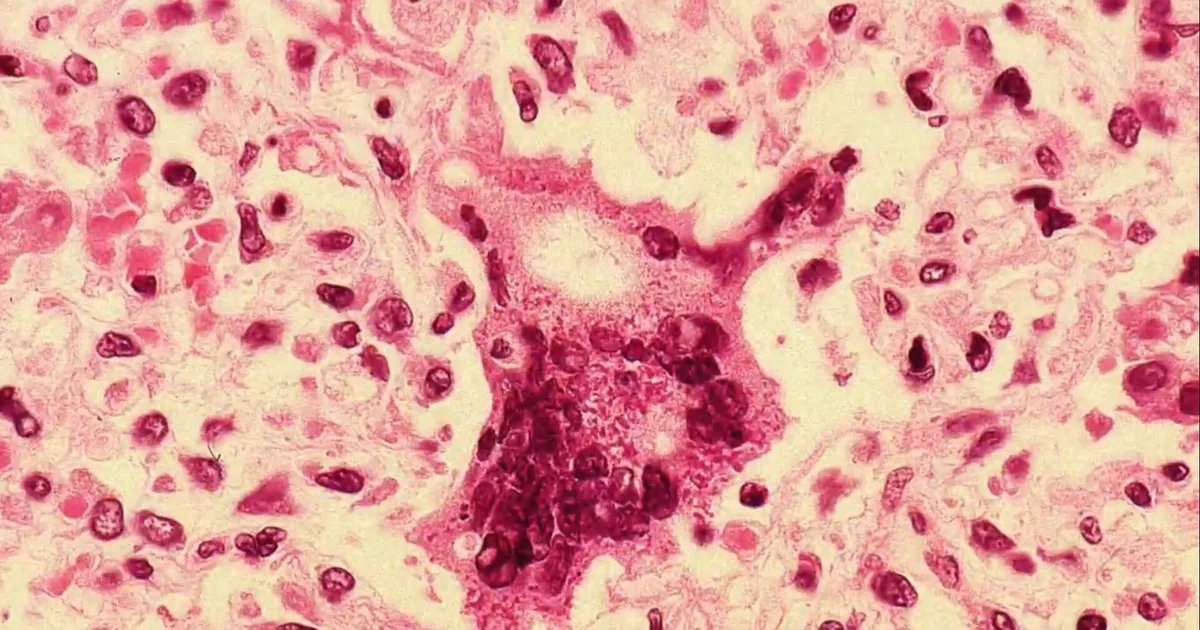 Measles outbreak at Florida university climbs to nearly 60 cases
