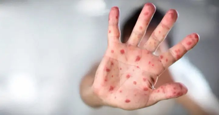 Manitoba sees 44 measles cases in first week of February – Winnipeg