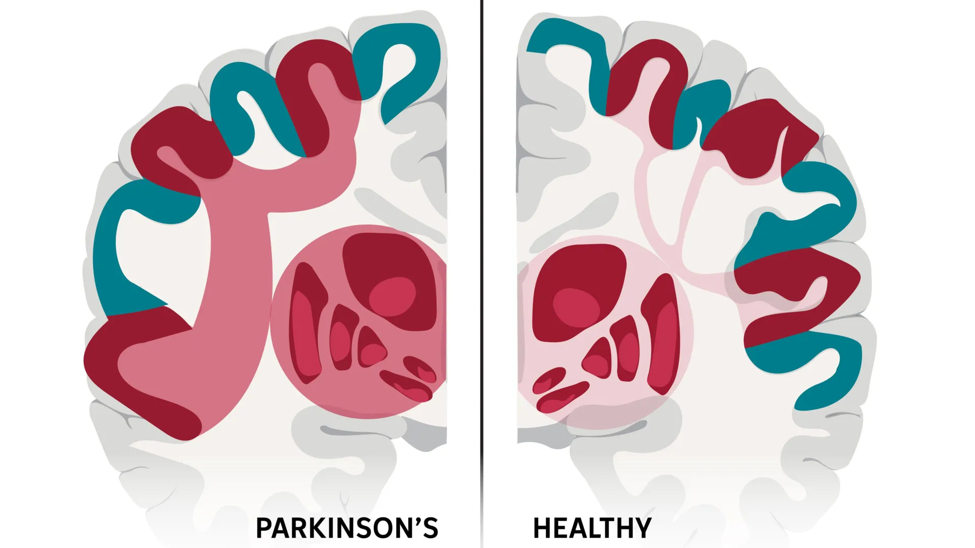 Scientists may have found the brain network behind Parkinson’s