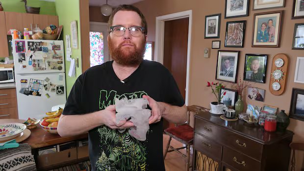Winnipegger who waited years for jaw surgery able to eat solids again after multiple procedures