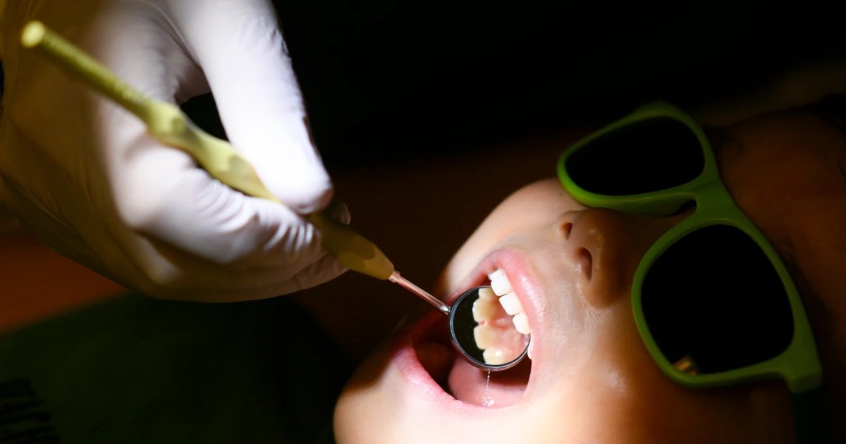 If states ban fluoride, kids with cavities and Medicaid costs could spike, study finds