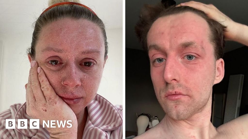 ‘Our skin is falling off and no-one can tell us why ‘