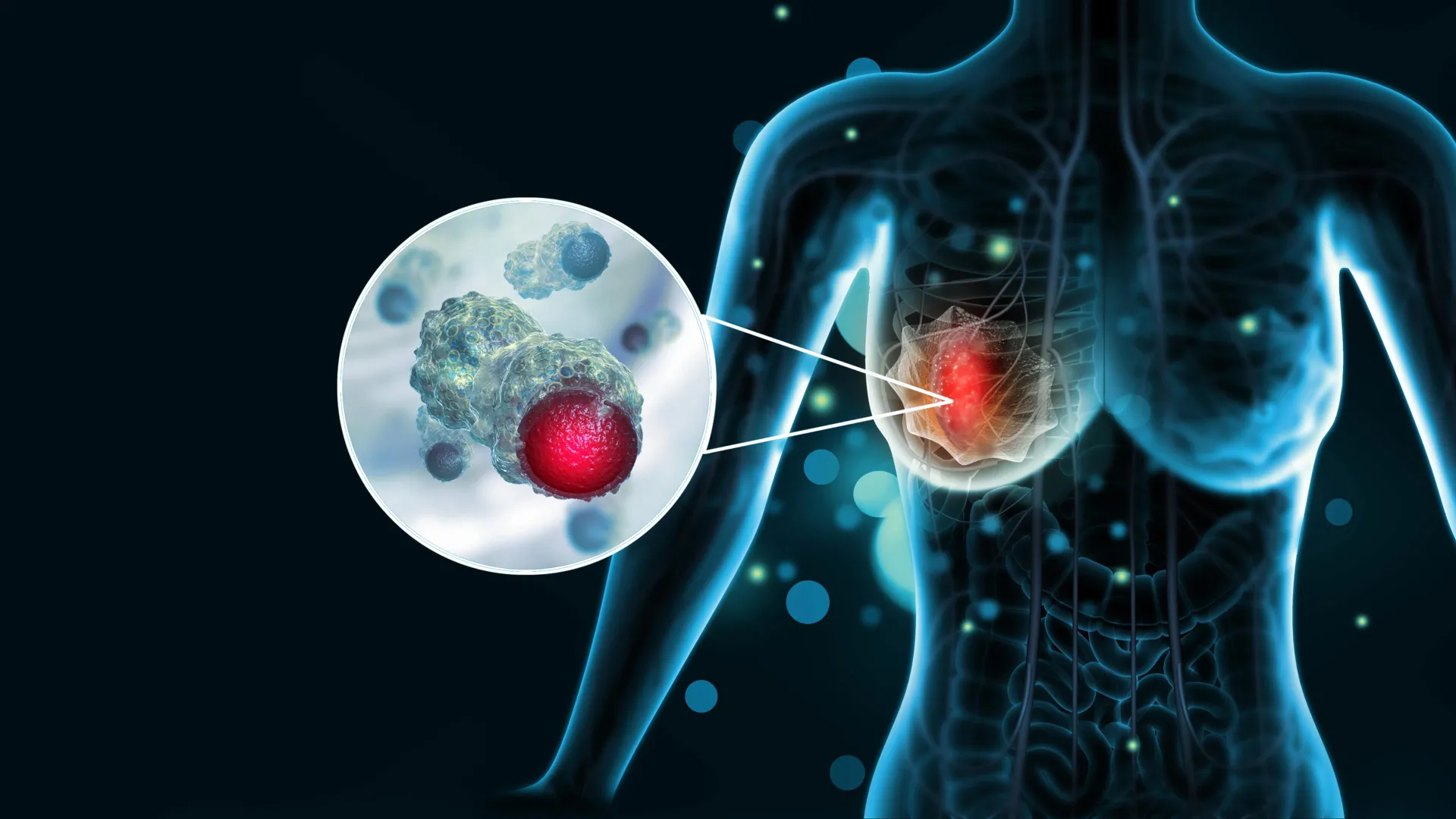 How aggressive breast cancer turns off the immune system