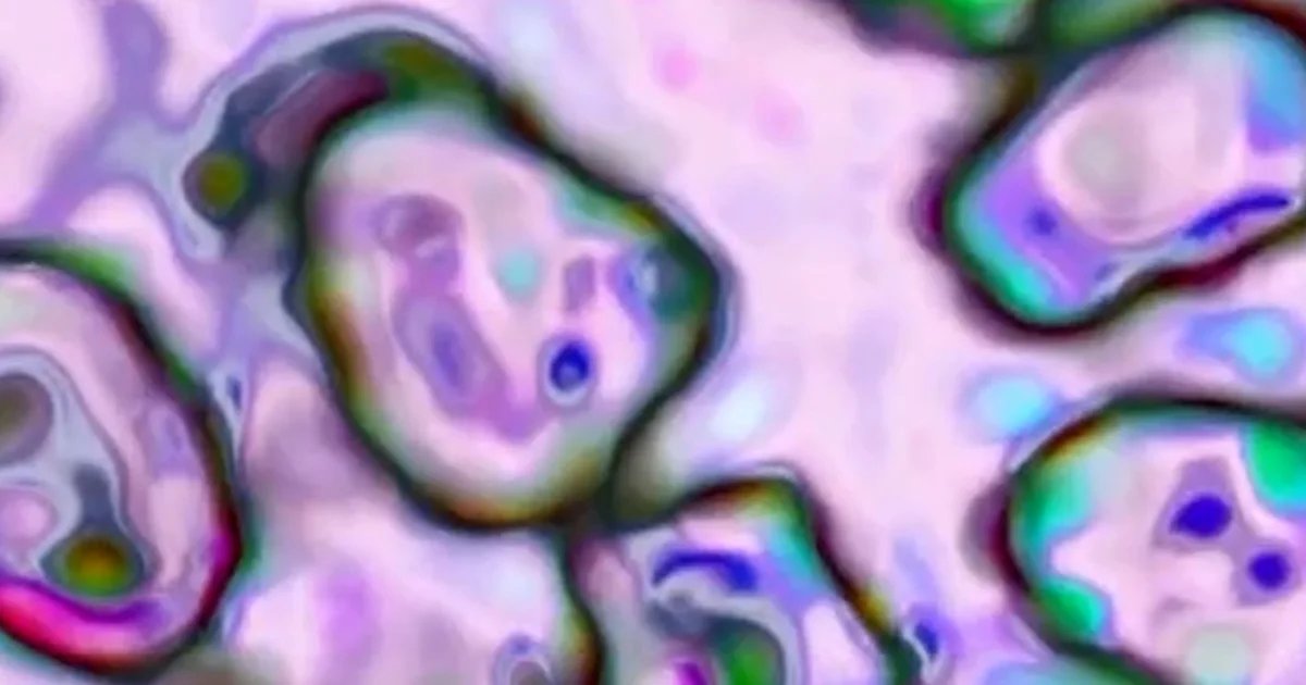 South Carolina’s measles outbreak declared over