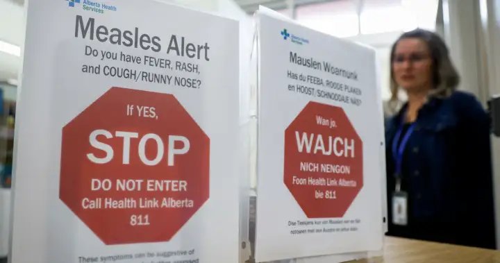 The largest measles outbreak in the U.S. is over. Where does Canada stand? – National