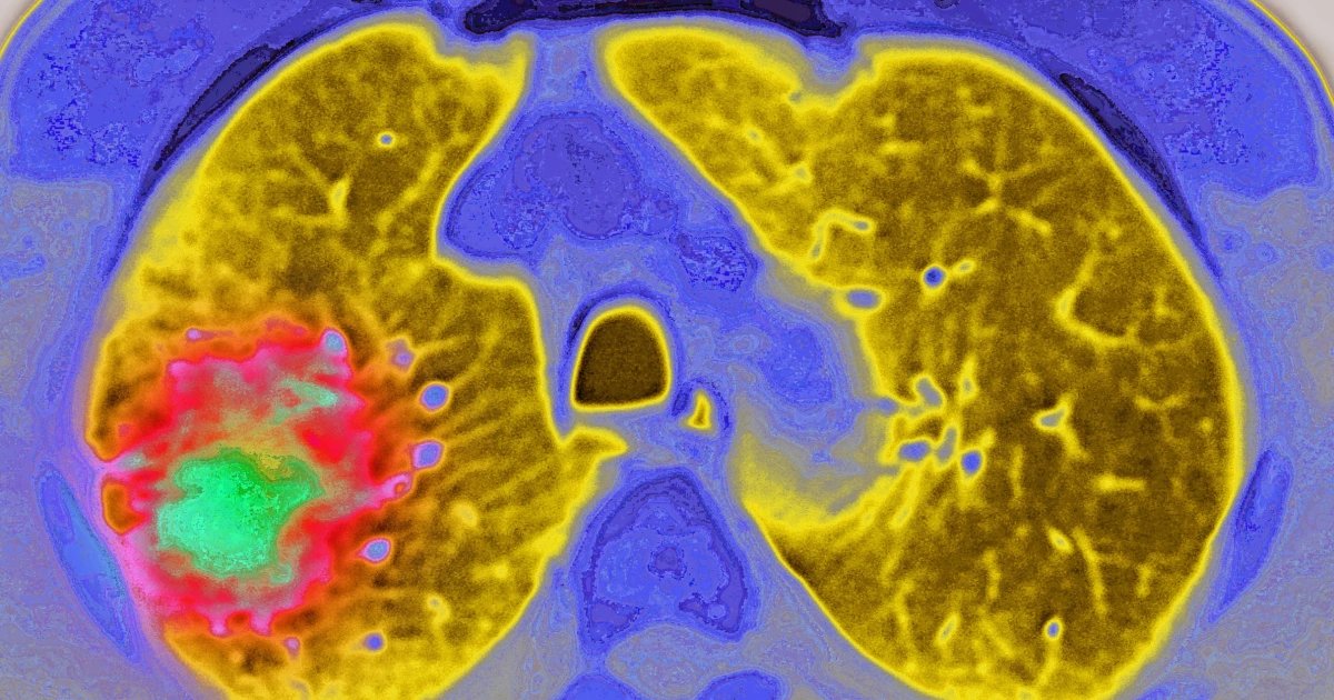 GLP-1 drugs may reduce the risk of cancer progressing, study suggests