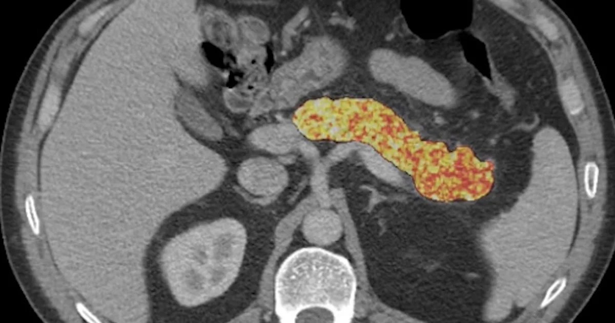 AI finds signs of pancreatic cancer before tumors develop
