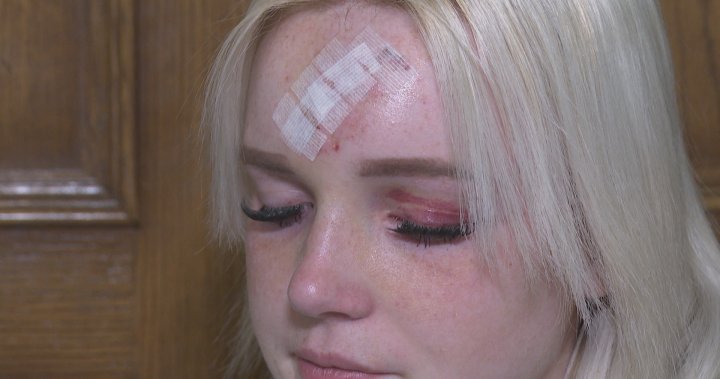 Okotoks family speaks out after driver hits a teen pedestrian from behind