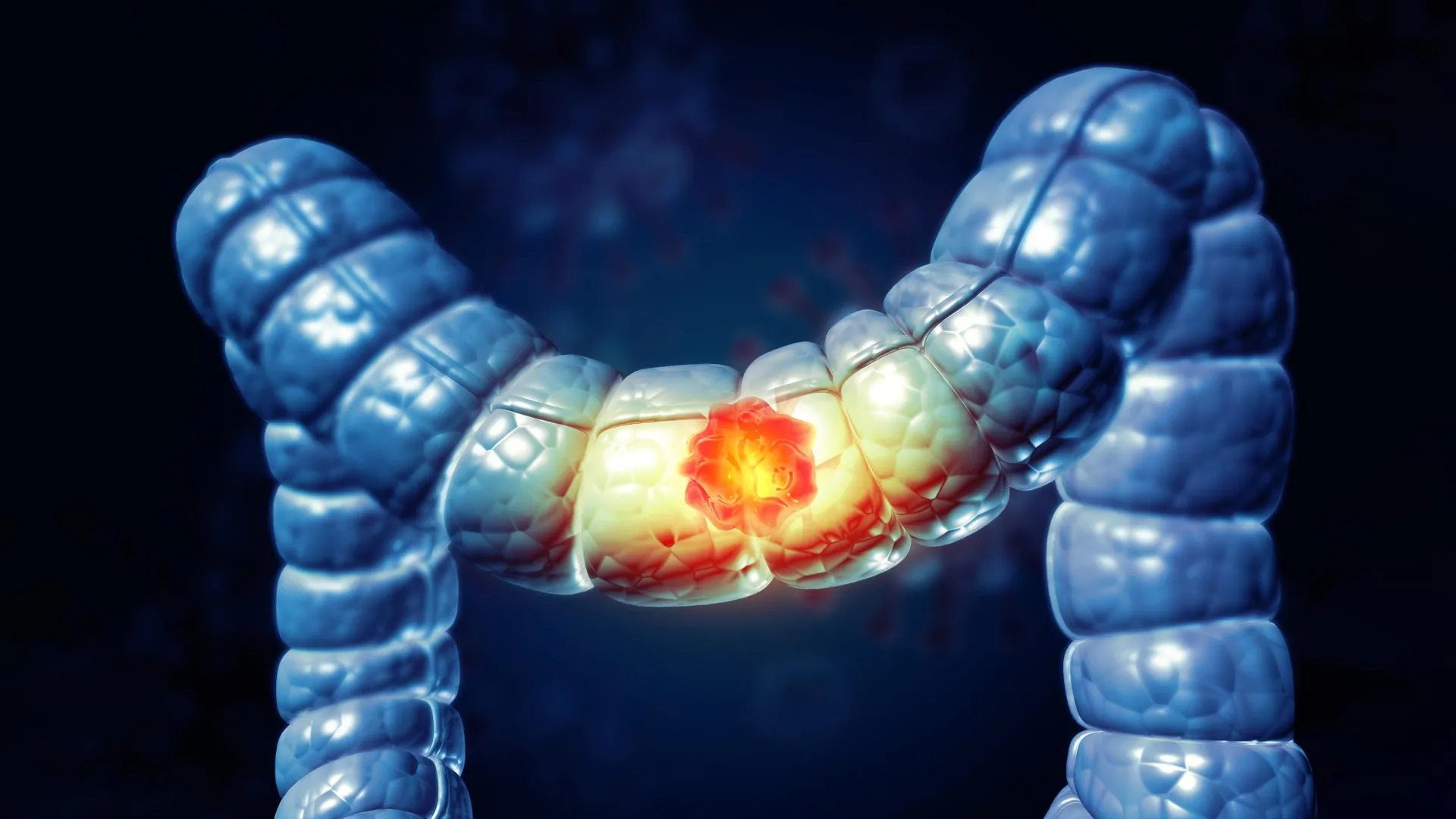 Colon cancer breakthrough keeps patients cancer-free for nearly 3 years