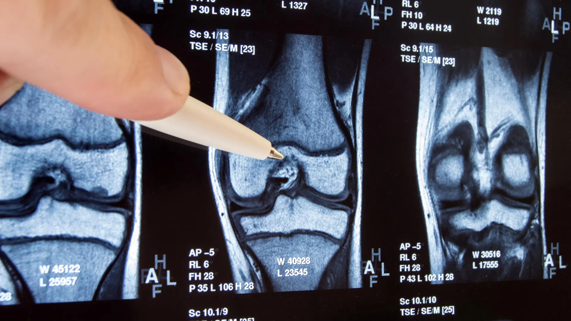 Common knee surgery found ineffective, may make things worse