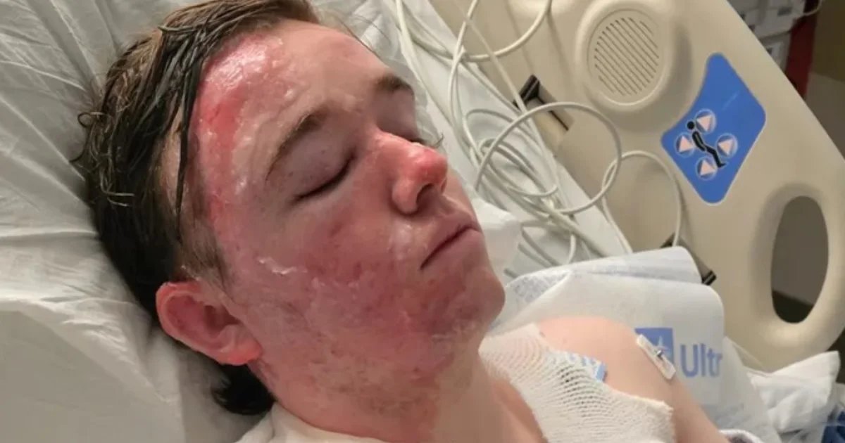 McDonald’s worker suffers severe burns on face and body after coworker throws hot oil on him, family says