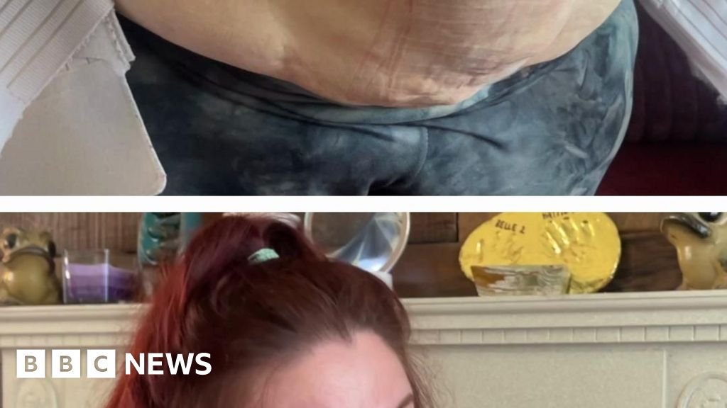 'Why I'm showing my hernia online'