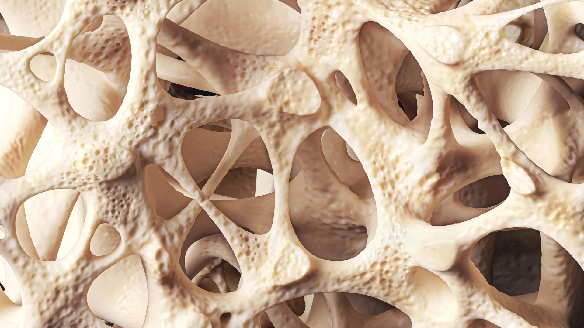 Osteopenia is silently weakening bones in millions of people