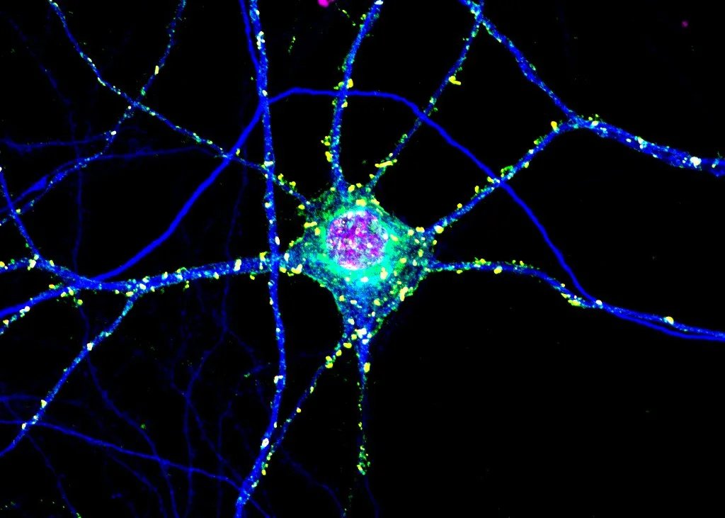 Toxic Clumps in Huntington’s Disease May Protect the Brain Too