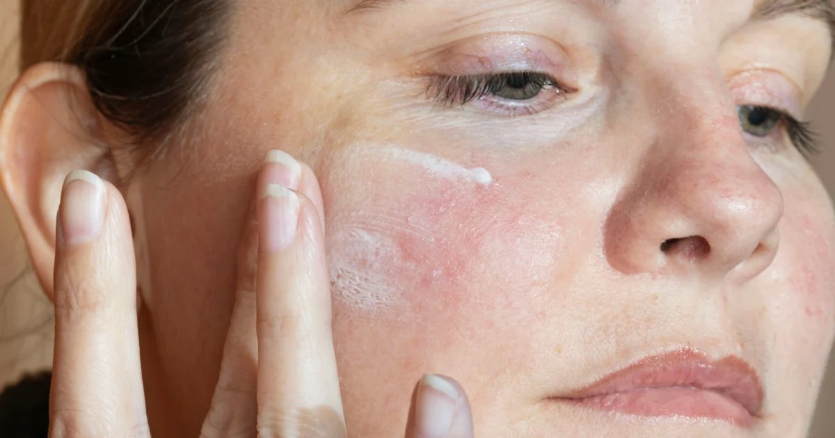 Best Rosacea Products for Redness Relief, According to Dermatologists