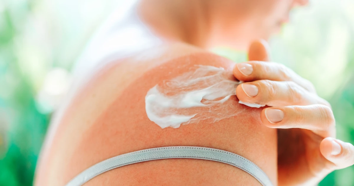 How to Treat and Avoid Heat Rash and Severe Sunburn