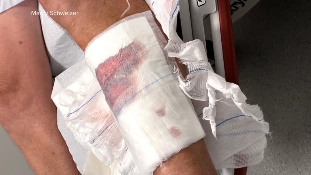 WATCH:  Connecticut man speaks out after shark attack in the Bahamas