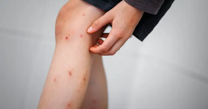 Edmonton kids experiencing ‘skeeter syndrome’ this wet, hot summer – Edmonton