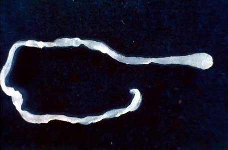 Surprised doctors find 10-inch worm in man’s groin during elective surgery