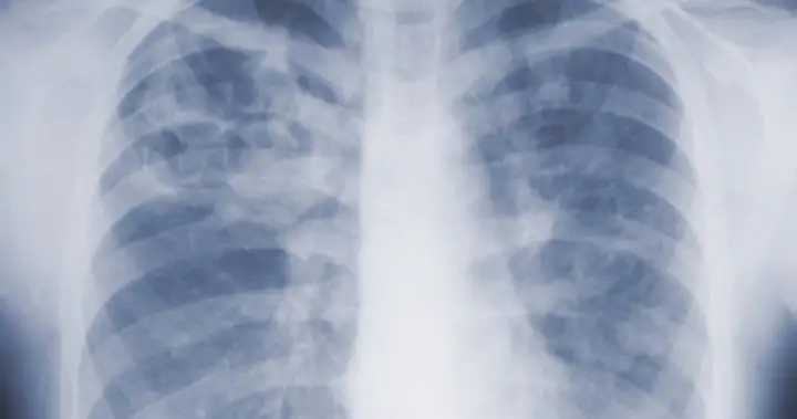 Are you underestimating mold-related illness? What U.S. study says – National