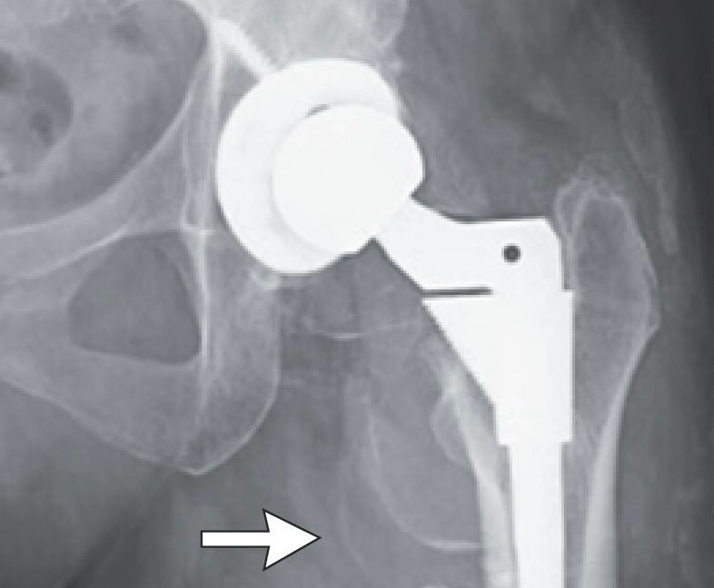 Woman’s hip replacement disintegrates, causing severe metal poisoning