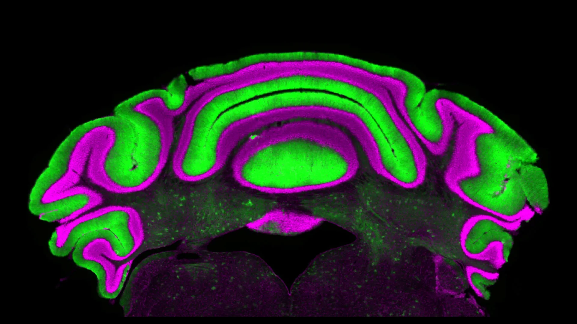 A surprising brain discovery is forcing scientists to rethink movement disorders