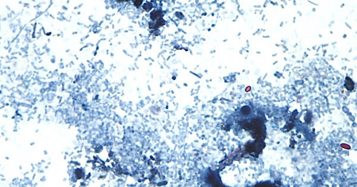 Michigan reports the first 2 US deaths related to a diarrhea-causing parasite