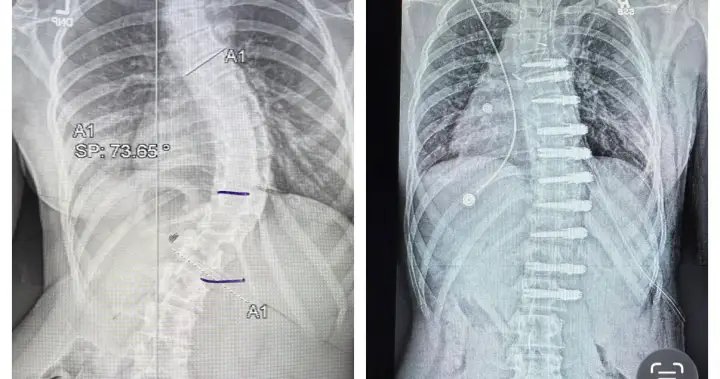 Alberta teen’s family sues government after nearly $200K out-of-country surgical bill