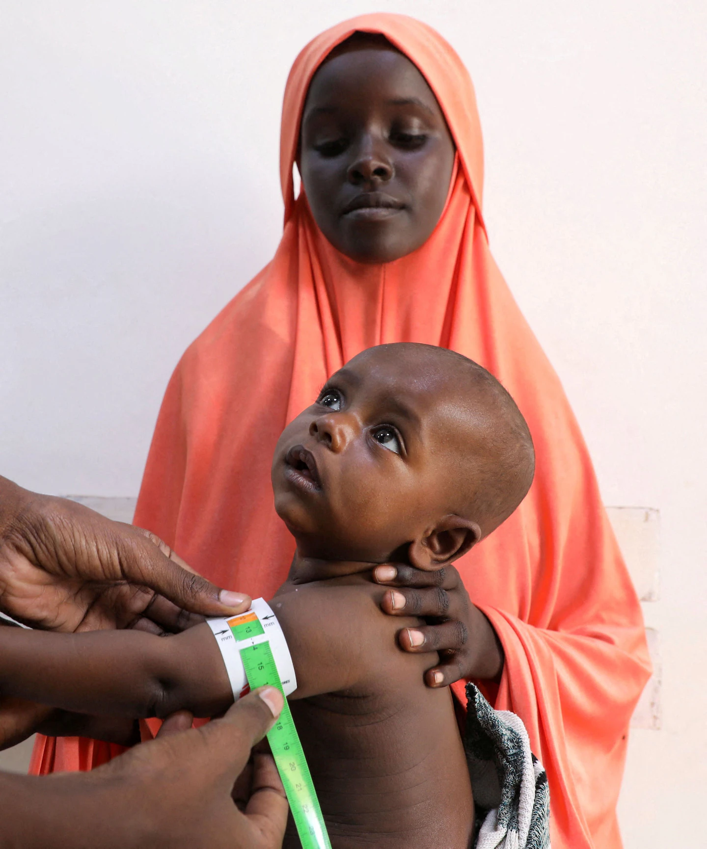 Severe malnutrition in Somalia is surging after U.S. cuts, aid groups say
