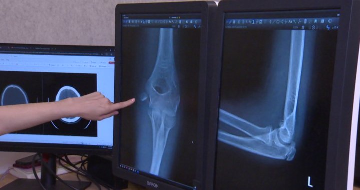 Doctors warn of ‘exponential’ rise in serious e-scooter injuries among kids