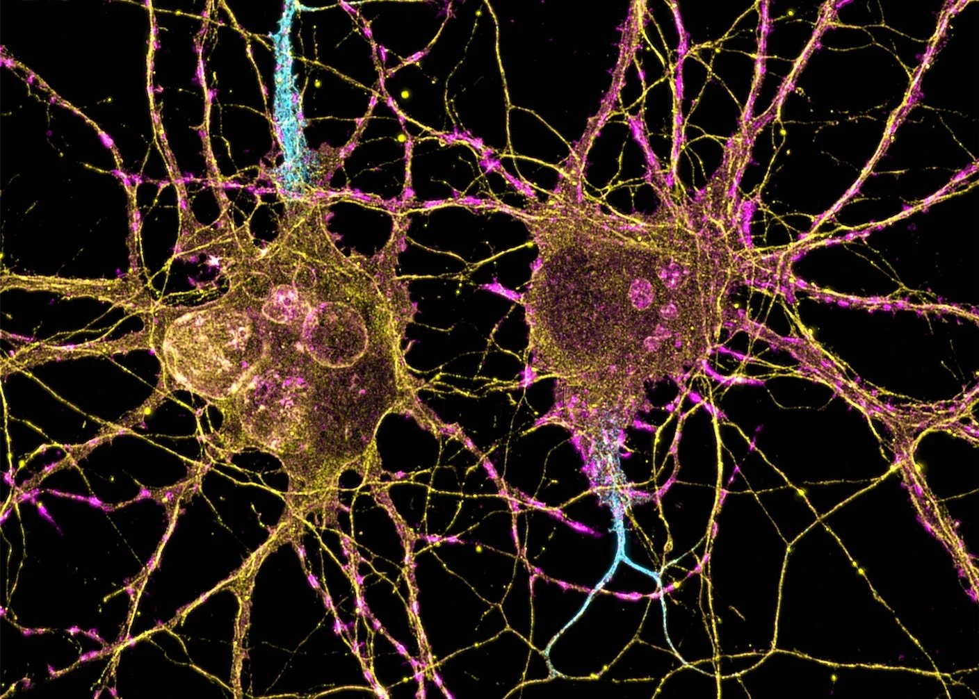 This Drug Makes New Neurons in the Brain. Scientists Say It Reversed Alzheimer’s Symptoms in Mice.