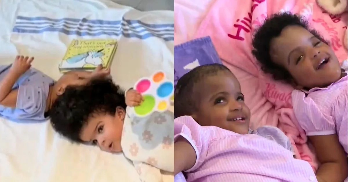 Twins conjoined at the head are separated in 25-hour surgery at St. Louis hospital