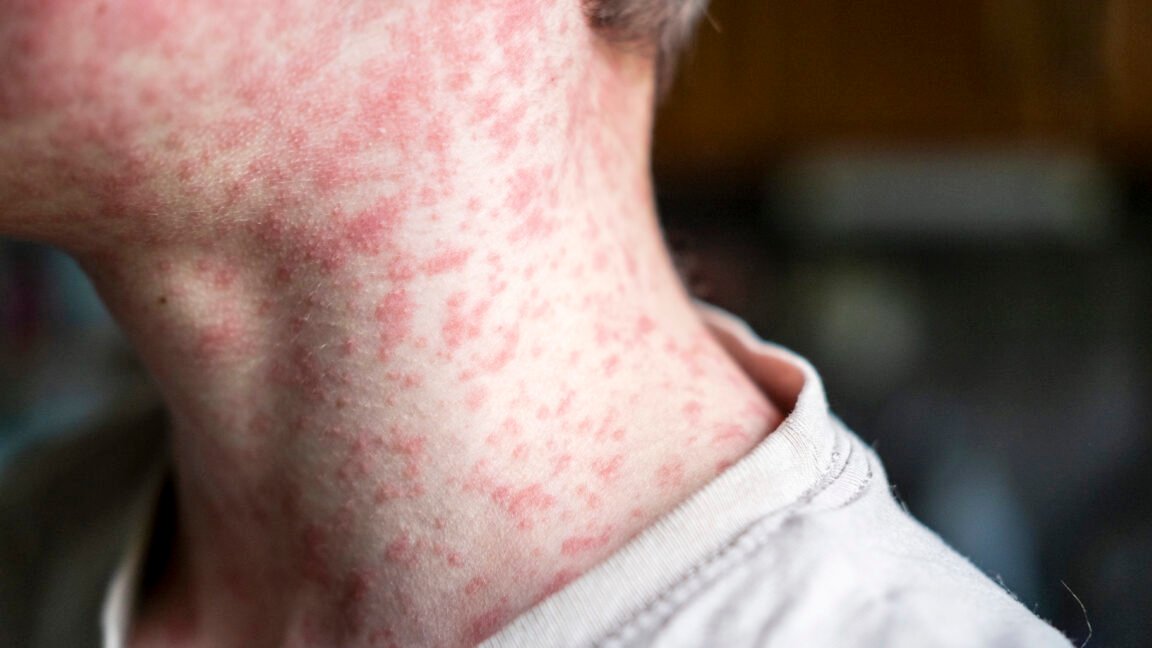 18-year-old dies of measles in PA from severe neurological complication