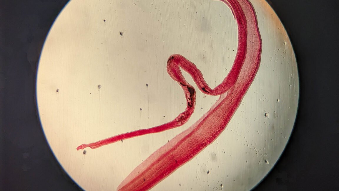 Woman’s brain worm infection confirmed after eggs grow tails in lab test