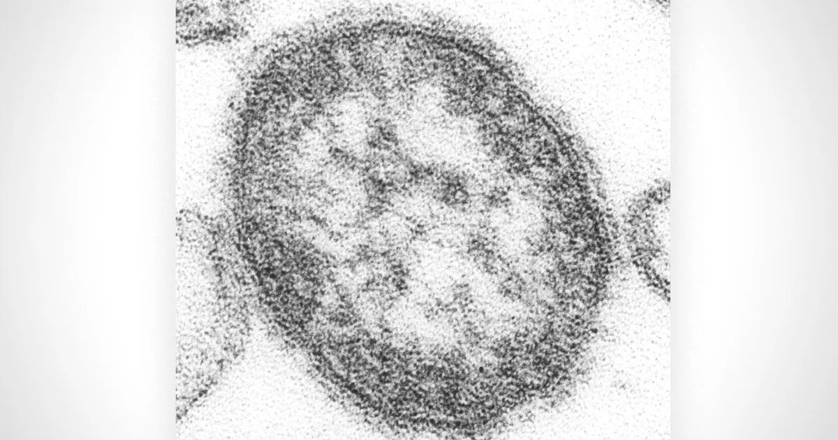 Pennsylvania woman dies of measles-related complications, Jefferson County Coroner reports