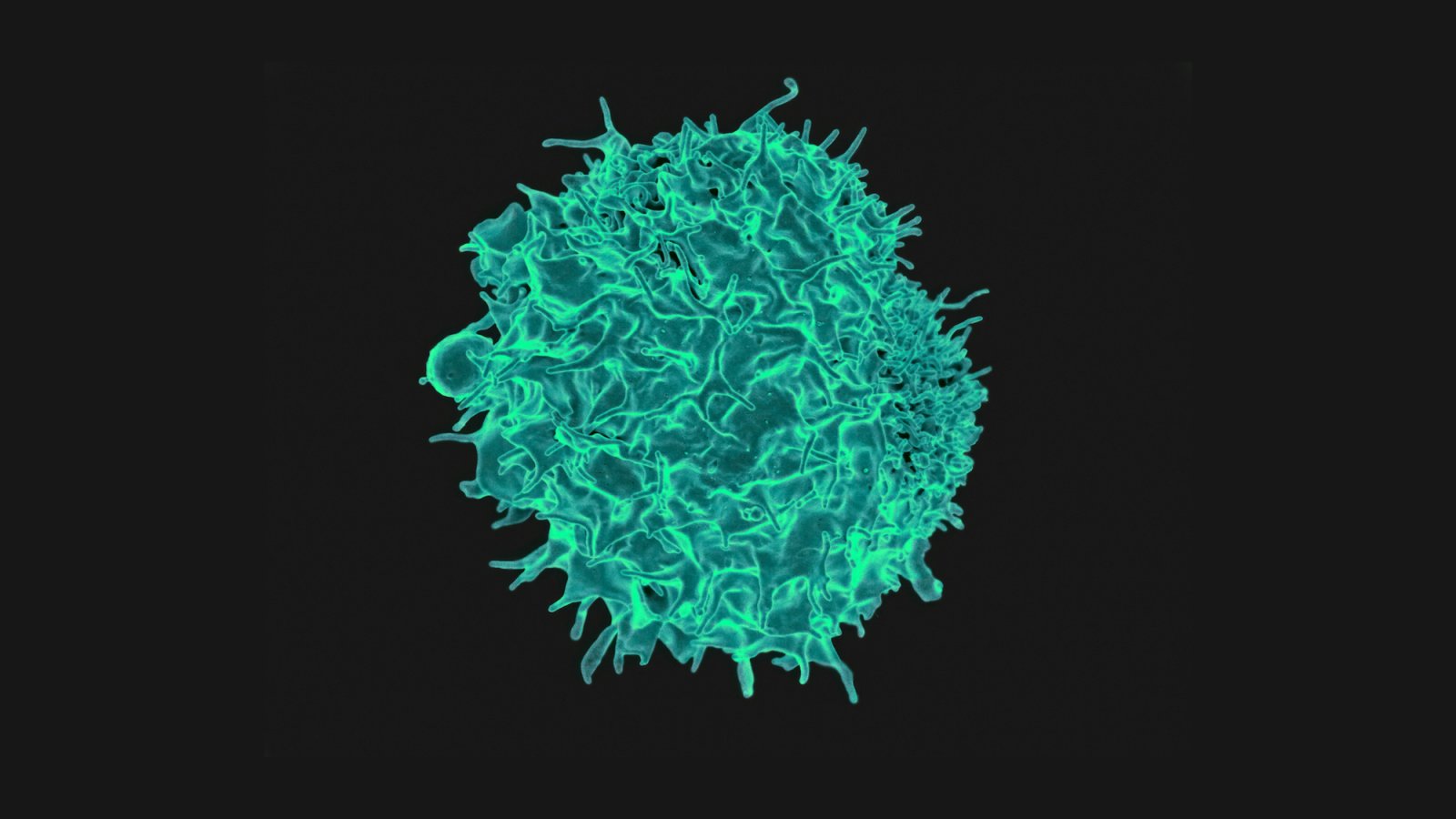 Single CAR T Injection Eases Multiple Sclerosis Symptoms in Small Trial