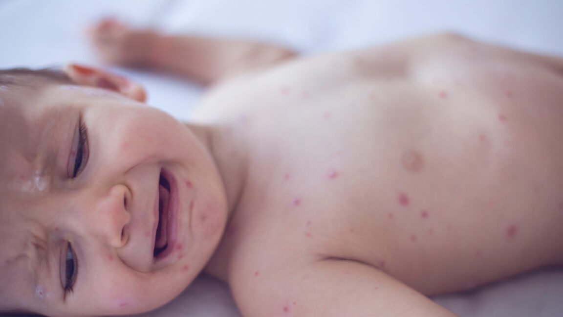 Pennsylvania issues alert on congenital measles—something US hasn’t seen for decades